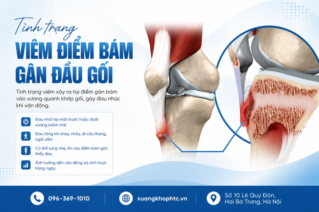 Tình Trạng Viêm Điểm Bám Gân Đầu Gối: Nguyên Nhân, Triệu Chứng Và Cách Khắc Phục