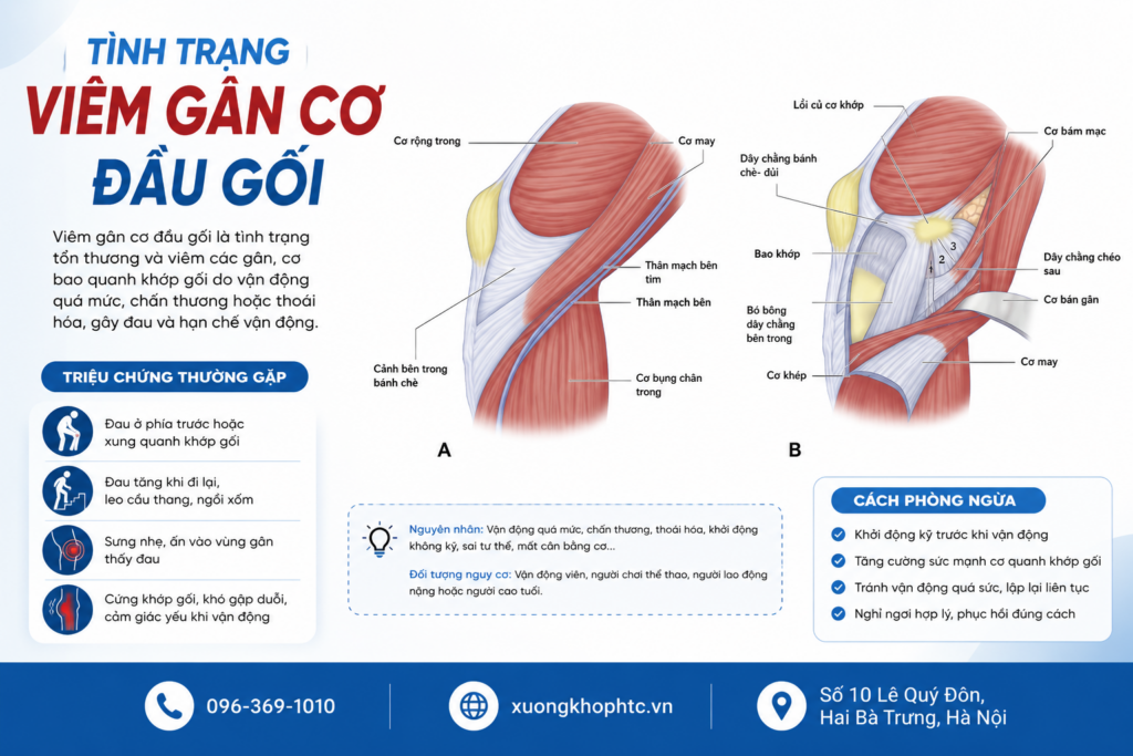 Tình Trạng Viêm Gân Cơ Đầu Gối: Nguyên Nhân, Triệu Chứng Và Cách Khắc Phục Hiệu Quả
