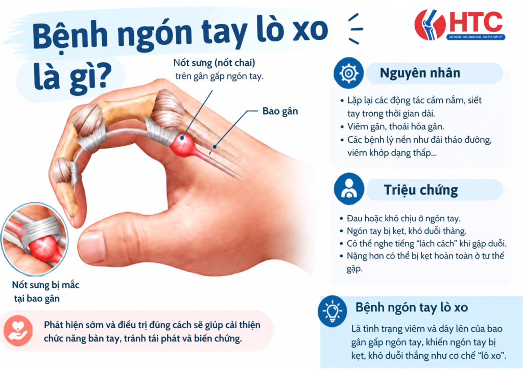 Bệnh ngón tay lò xo là gì? Nguyên nhân và triệu chứng