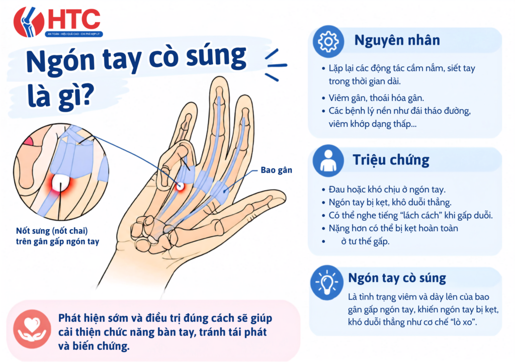 Ngón tay cò súng là gì? Vì sao ngón tay bị kẹt khi gấp duỗi?
