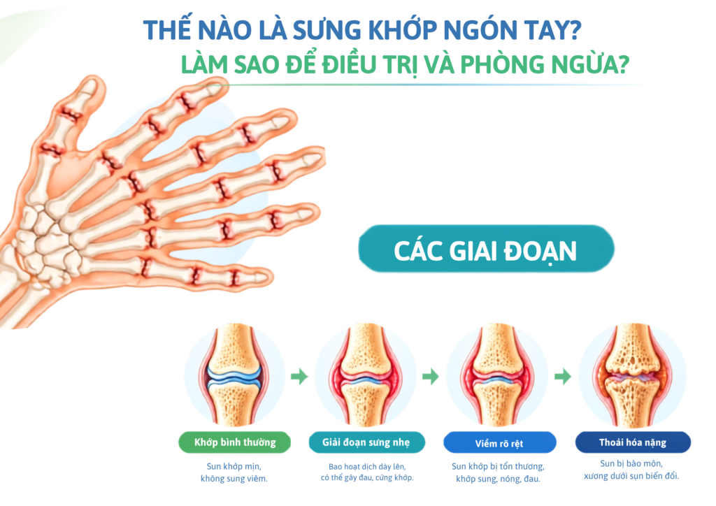 Thế Nào Là Sưng Khớp Ngón Tay? Cách Điều Trị Và Phòng Ngừa
