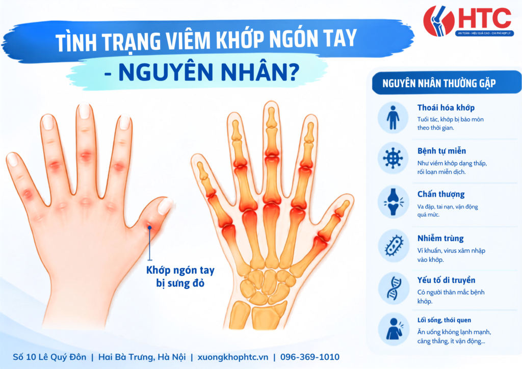 Tình trạng viêm khớp ngón tay – Nguyên nhân?