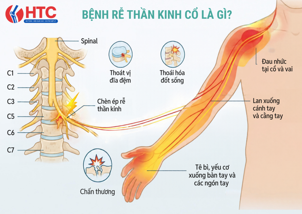 Bệnh rễ thần kinh cổ là gì? Nguyên nhân, triệu chứng và cách nhận biết