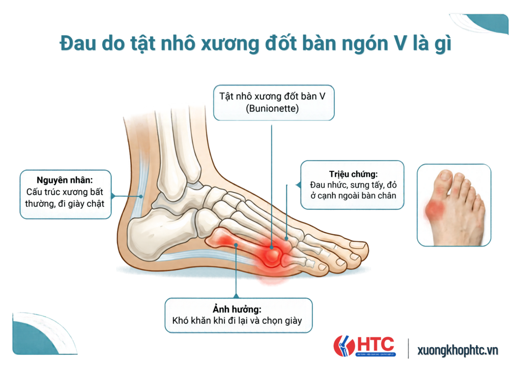 Đau do tật nhô xương đốt bàn ngón V là gì? Dấu hiệu và hướng xử trí