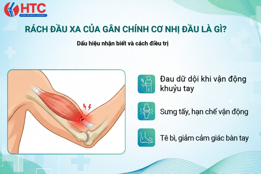 Rách đầu xa của gân chính cơ nhị đầu là gì? Nguyên nhân, dấu hiệu và phục hồi