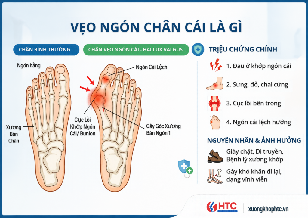 Vẹo Ngón Chân Cái Là Gì? Nguyên Nhân, Dấu Hiệu Và Cách Cải Thiện