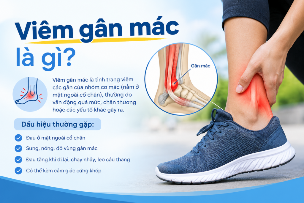 Viêm gân mác là gì? Nguyên nhân, triệu chứng và cách nhận biết