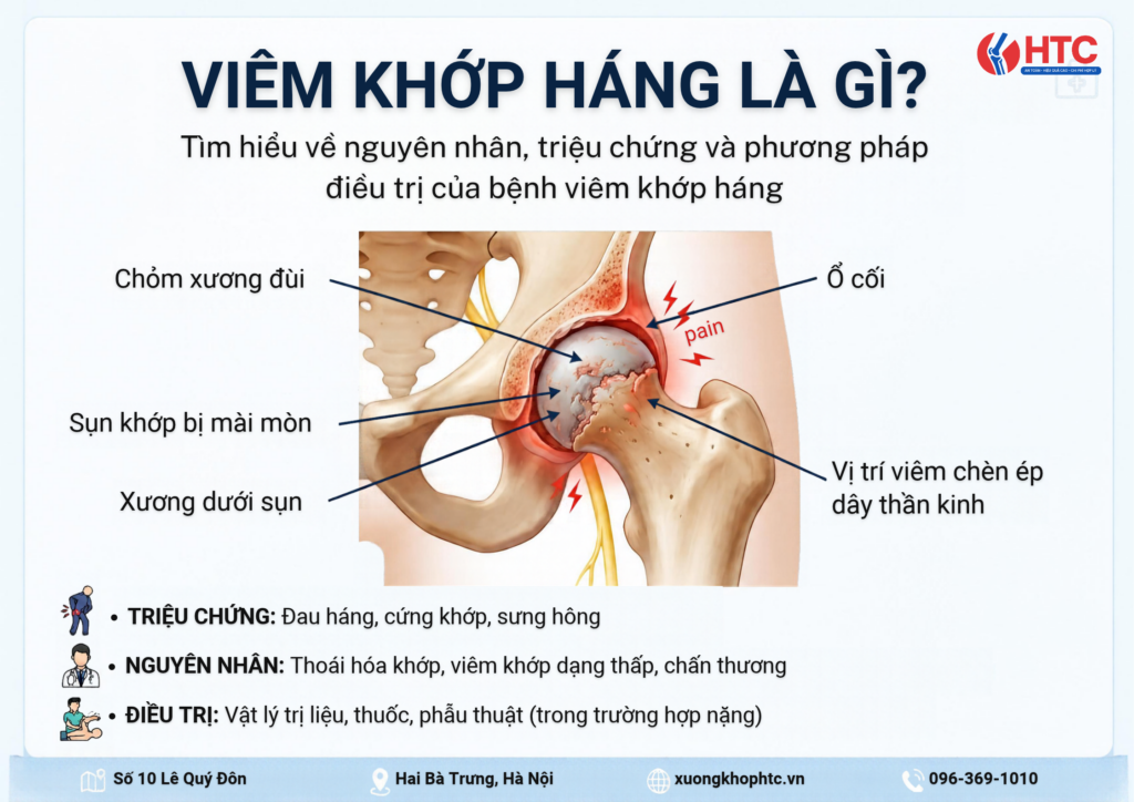 Viêm khớp háng là gì? Nguyên nhân, triệu chứng và điều trị