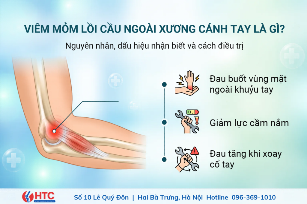 Viêm mỏm lồi cầu ngoài xương cánh tay là gì? Nguyên nhân và cách khắc phục