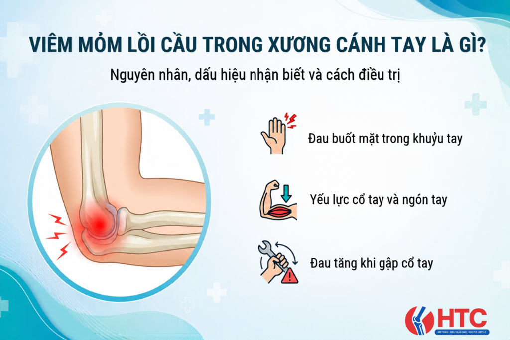 Viêm mỏm lồi cầu trong xương cánh tay là gì? Dấu hiệu và phương pháp phục hồi