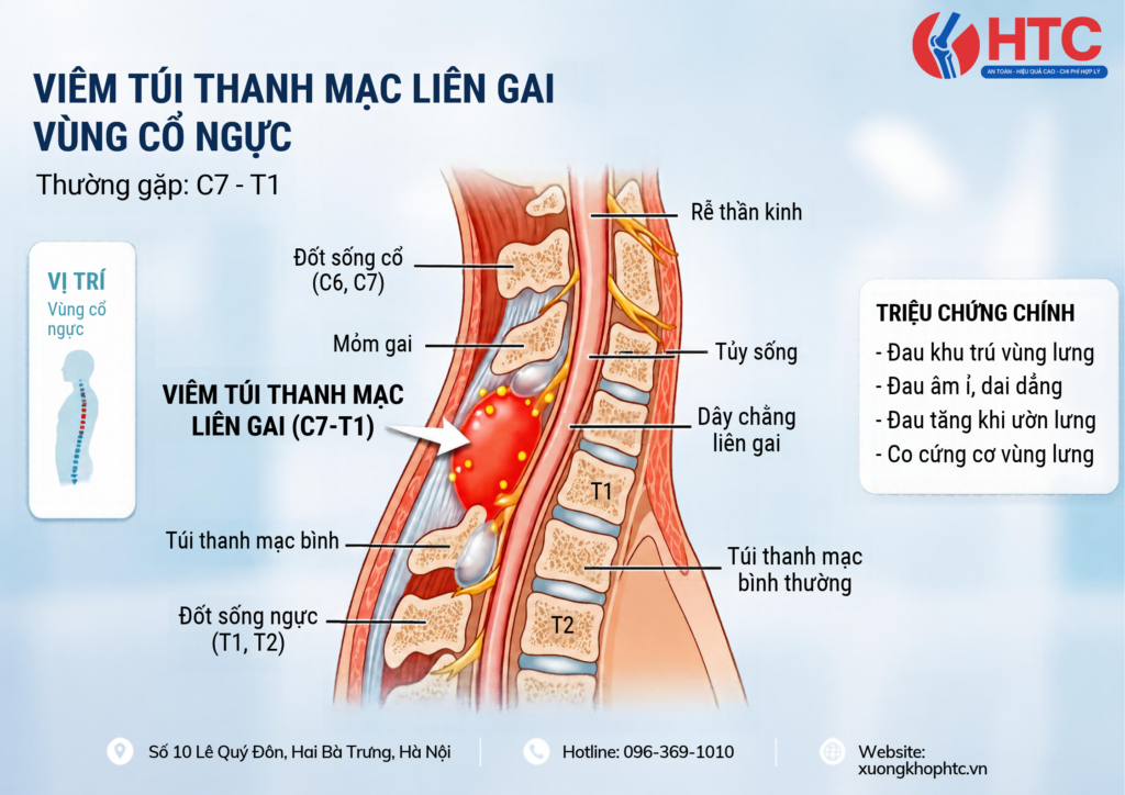 Viêm Túi Thanh Mạc Liên Gai Vùng Cổ Ngực: Nguyên Nhân, Triệu Chứng Và Cách Điều Trị